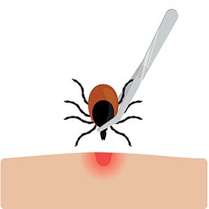 Pull directly up and away from the skin to remove the tick. Do not pull the body of the tick, because squeezing the body can allow the tick to regurgitate the contents back into the bite, possibly causing infection. It also increases the chance the head will detach and stay imbedded in the skin.