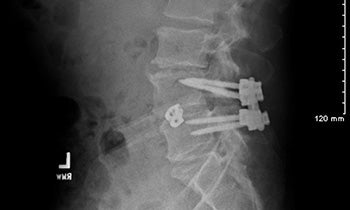 Image shows fusion of L-4 and L-5 vertebrae